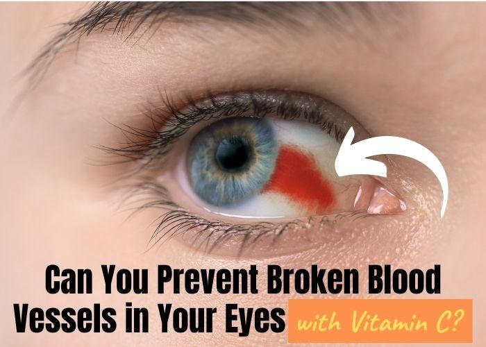 How to Prevent Broken Blood Vessels in Eyes with Vitamin C